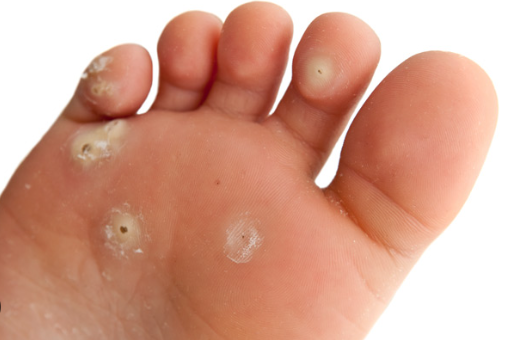 Traitement des verrues